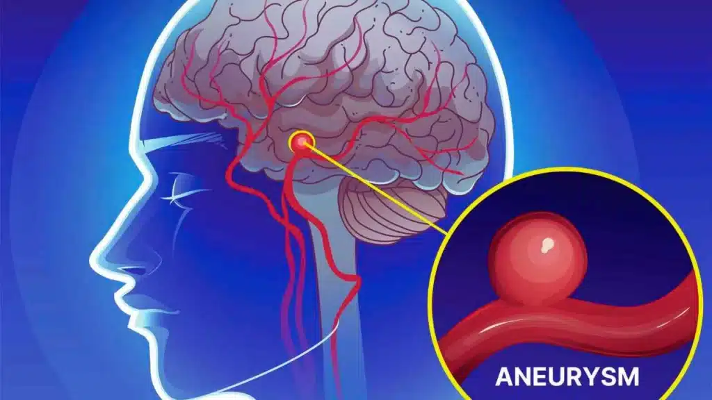 Brain Aneurysm Survival Rate and Current Facts 2025