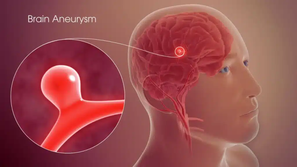 Brain Aneurysm Survival Rate by filmy4wap.pro